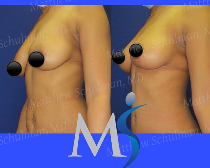Breast Lift Before and After NYC