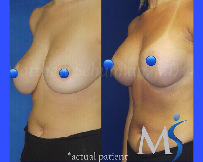 Breast Lift NYC Before and After
