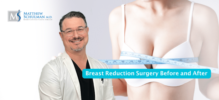 Breast Reduction Surgery Before And After