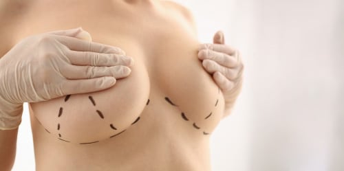 Breast implants gone wrong