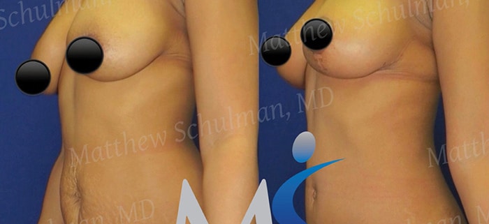 Breast lift NYC Patient 2