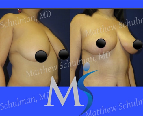 Breast lift NYC Patient 2