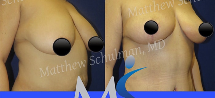 Breast lift NYC Patient 2