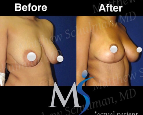 Breast lift in NYC Patient 1