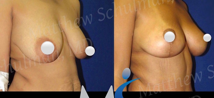 Breast lift in NYC Patient 1