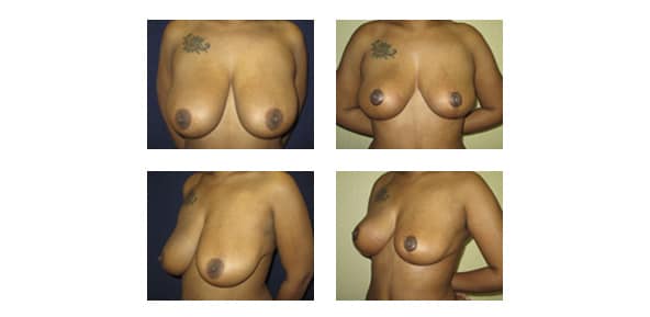 Breast reduction surgery recovery week by week