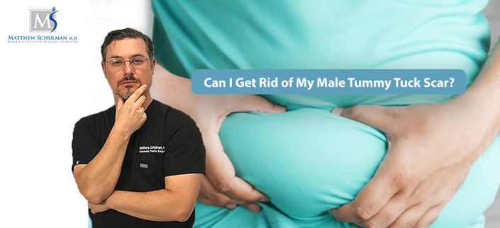 male tummy tuck scar