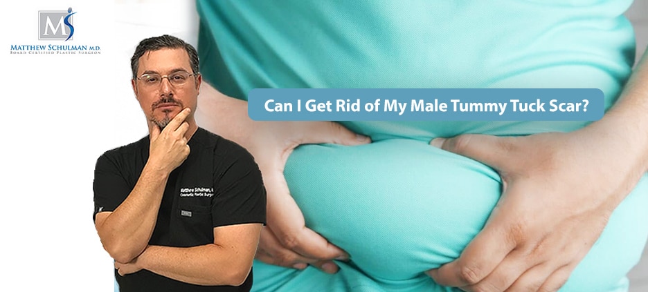 male tummy tuck scar