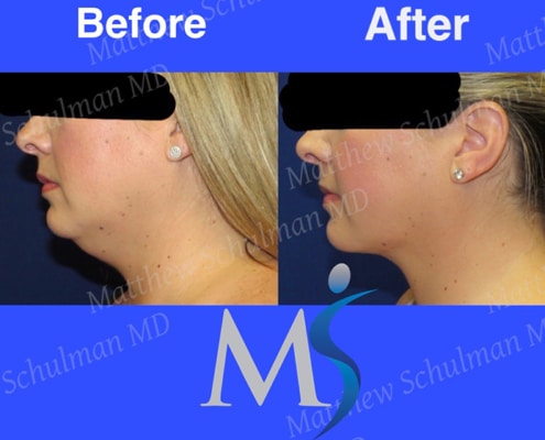 Chin Lipo New York City Patient 3