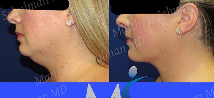 Chin Lipo New York City Patient 3