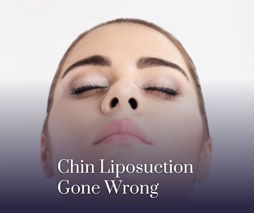 Chin Liposuction Gone Wrong