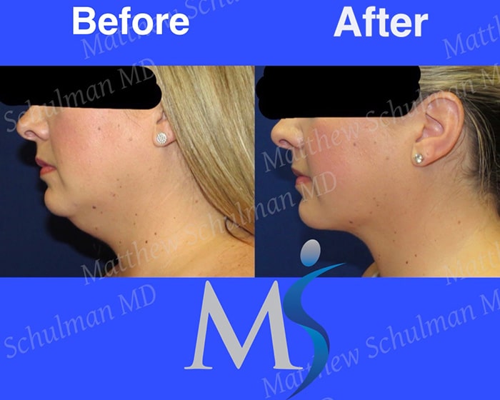 Chin Liposuction NYC