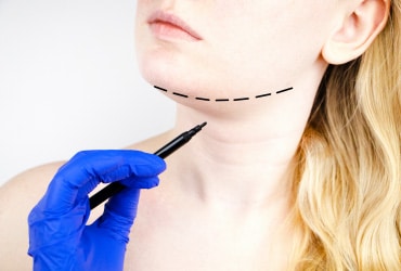 Chin Liposuction plastic surgery