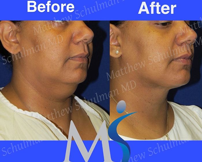 Chin Liposuction Reading