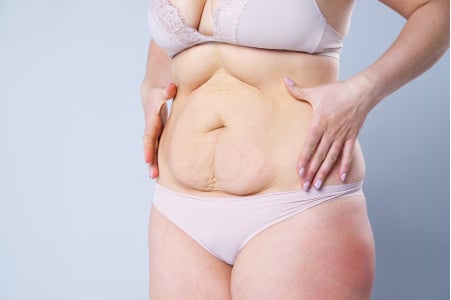Cost of a tummy tuck