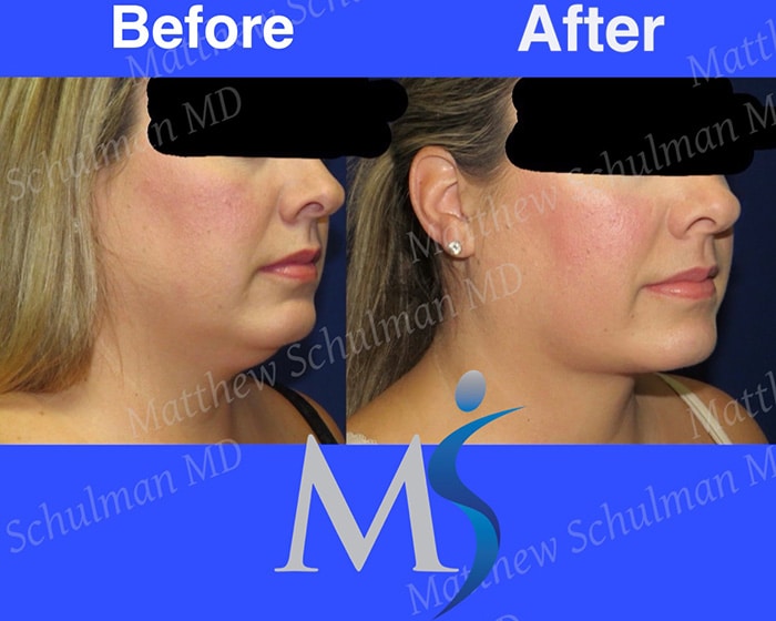 Double Chin Liposuction Great Neck