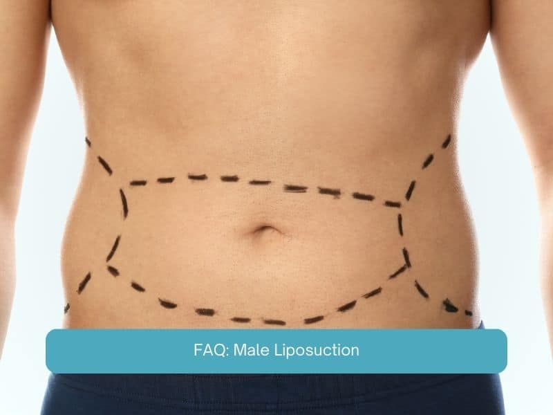 FAQ Male Liposuction