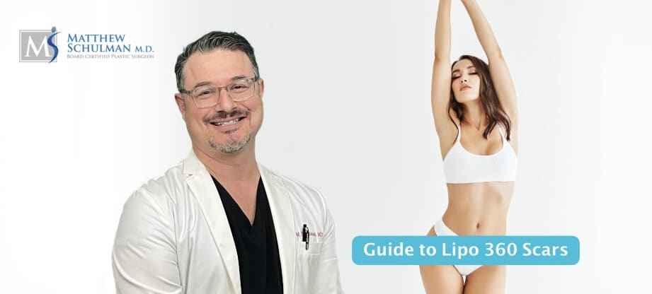 Guide To Lipo 360 Scars