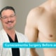 Gynecomastia Surgery Before And After
