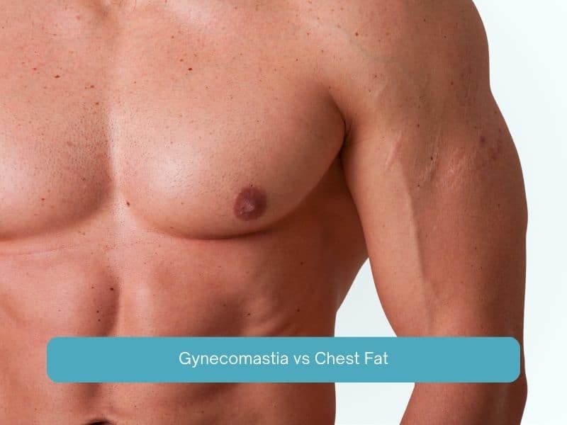 Gynecomastia vs Chest Fat