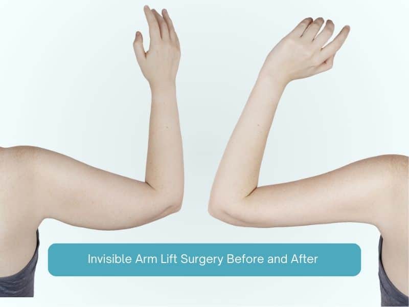 Invisible Arm Lift Surgery Before and After