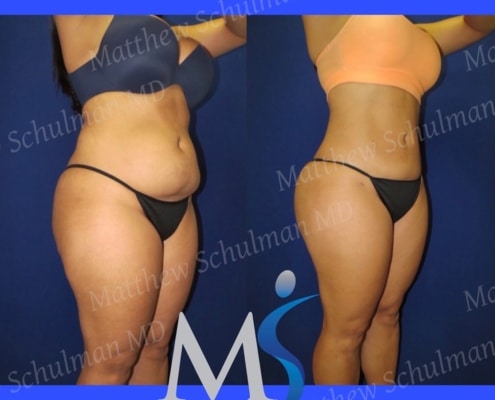 Lipo 360 New York City