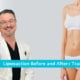 Liposuction Before And After Transforming Lives