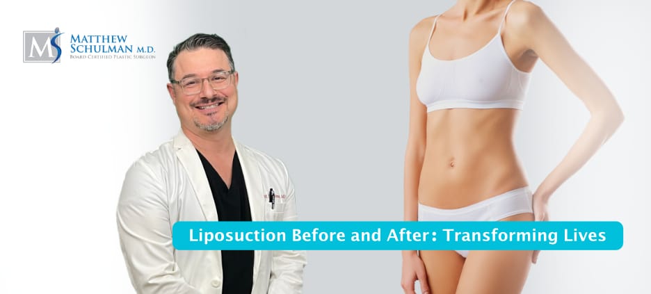 Liposuction Before And After Transforming Lives