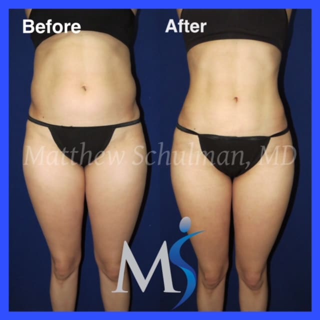 Liposuction Before and After NYC