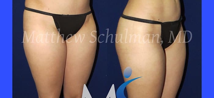 Liposuction NYC