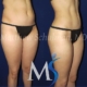 Liposuction NYC