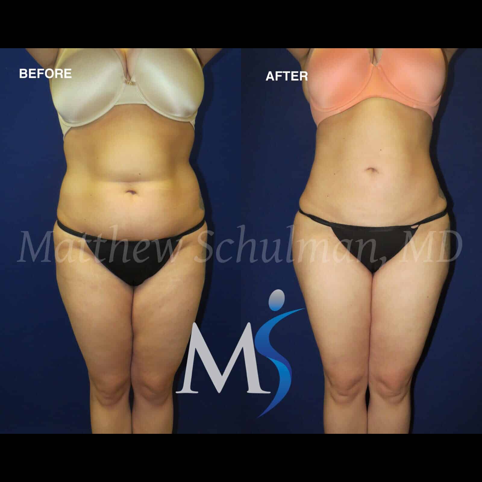 Liposuction NYC Before and After
