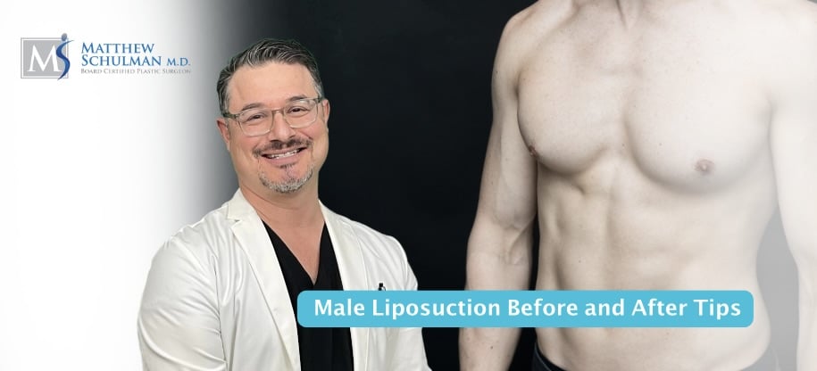 Male Liposuction Before And After
