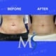 NYC Belly Button Surgery