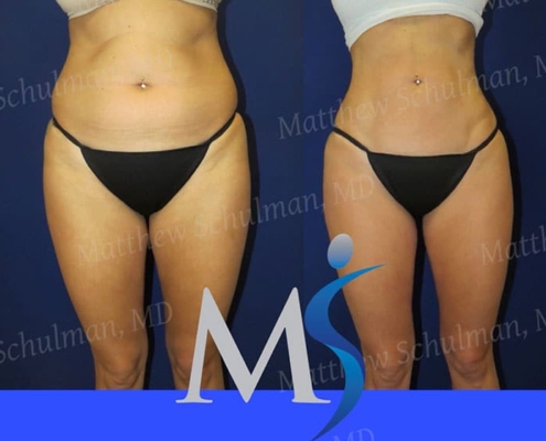 NYC Liposuction