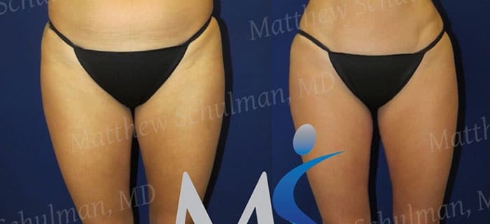 NYC Liposuction