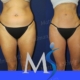 NYC Liposuction