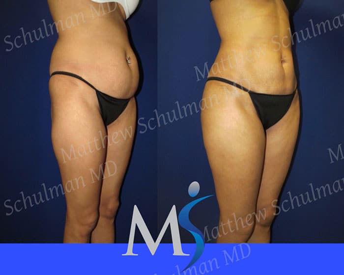 NYC Tummy Tuck