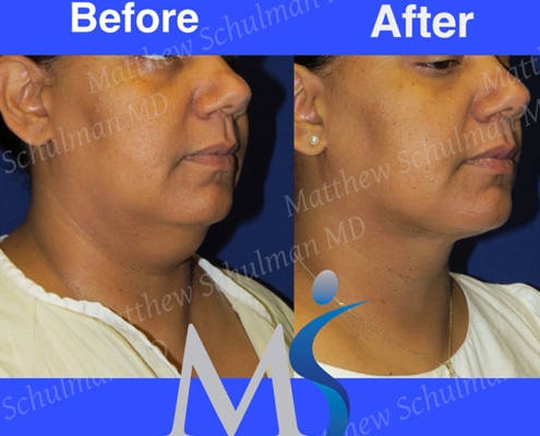 Neck Lipo NYC patient 1