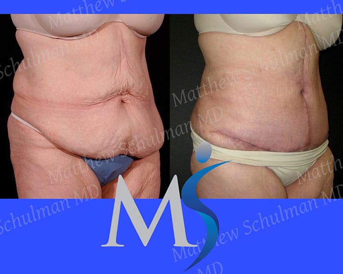 Plastic Surgery After Massive Weight Loss NYC