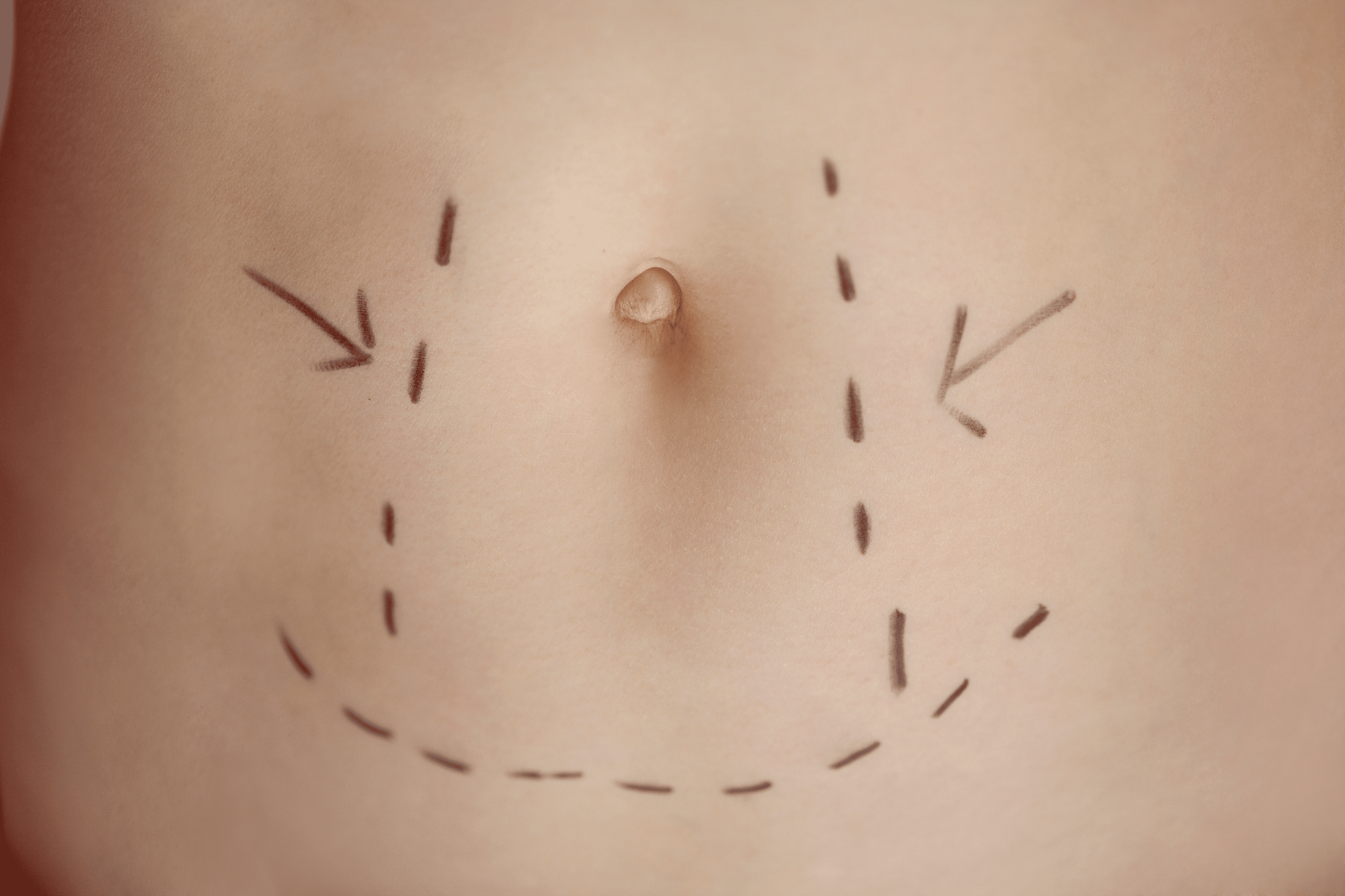 Plastic Surgery After Weight Loss Covered By Insurance