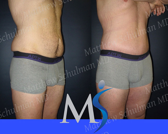 Plastic Surgery After Weight Loss NYC