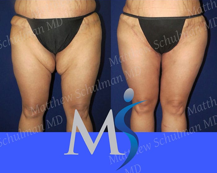 Plastic Surgery To Remove Excess Skin After Weight Loss NYC