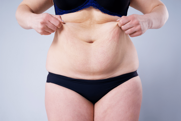 Surgery To Remove Excess Skin After Weight Loss