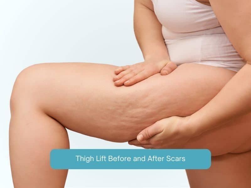 Thigh Lift Before and After Scars