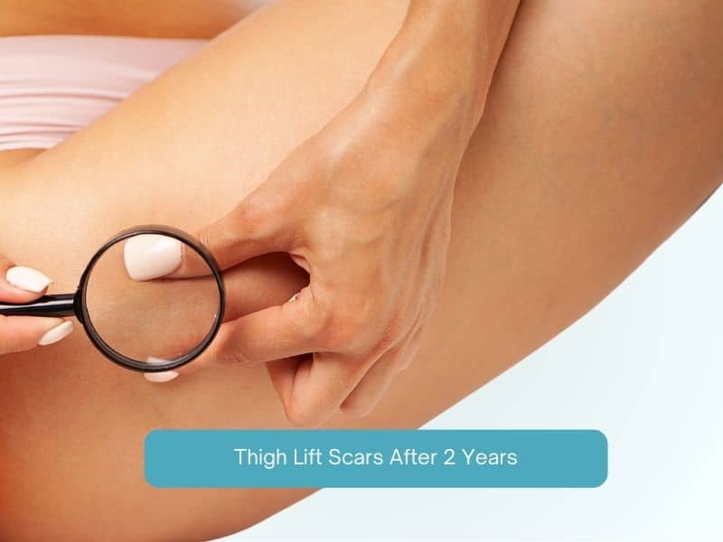 Thigh Lift Scars after 2 years