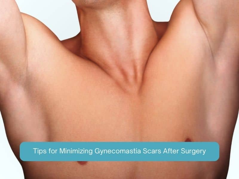Tips for Minimizing Gynecomastia Scars After Surgery