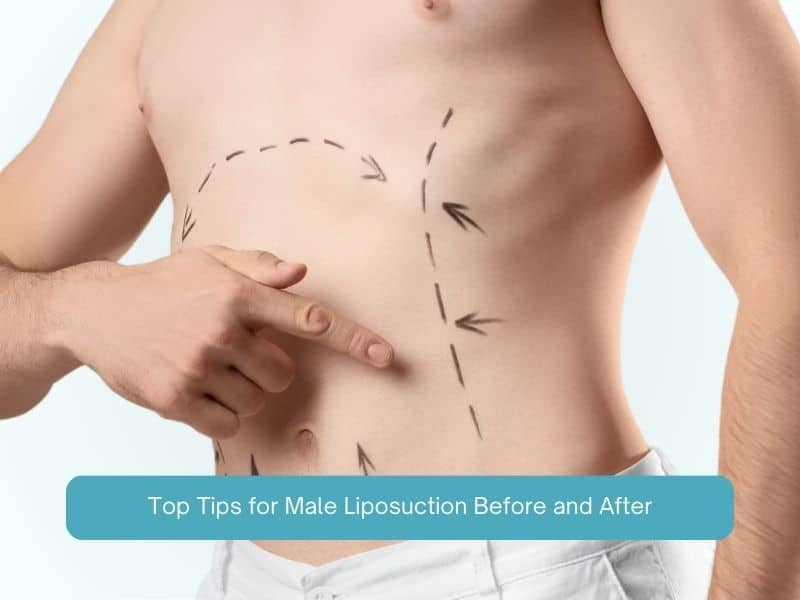 Top Tips for Male Liposuction Before and After