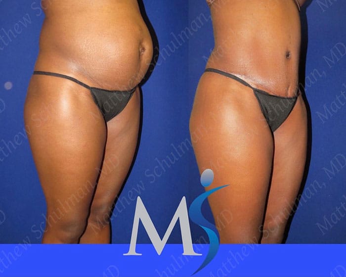 Tummy Tuck Before and After NYC