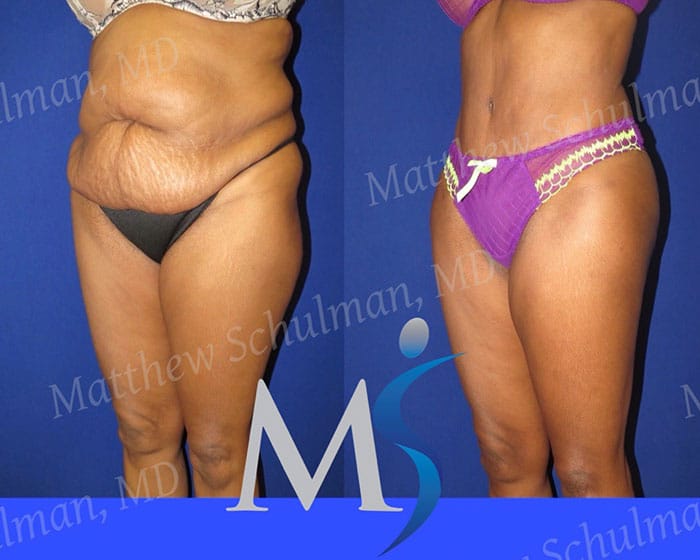 Tummy Tuck Before and After Pictures With Stretch Marks